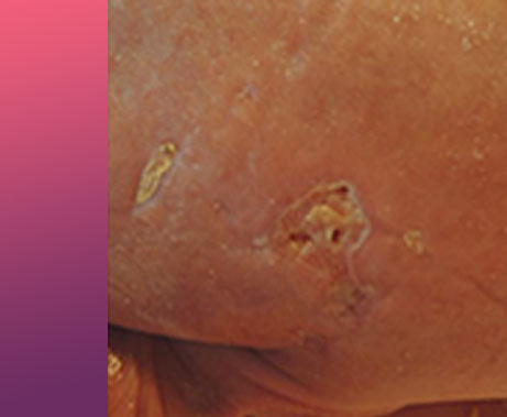 Neonatal Case Study of Treatment of Purpura Fulminans Over 28 Days with CEPROTIN